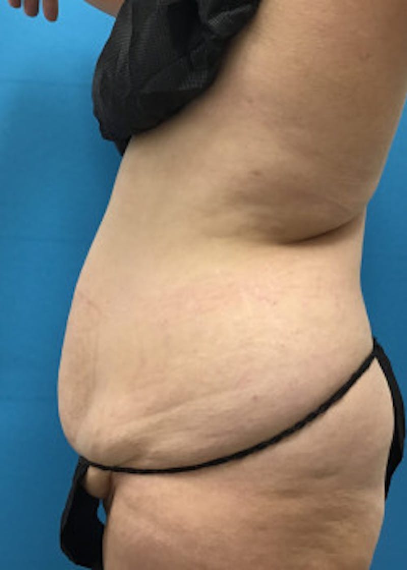 Tummy Tuck Before & After Gallery - Patient 46612080 - Image 5
