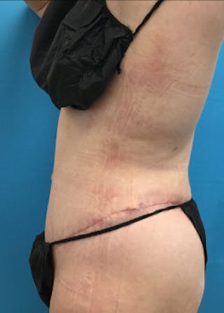 Tummy Tuck Before & After Gallery - Patient 46612080 - Image 6