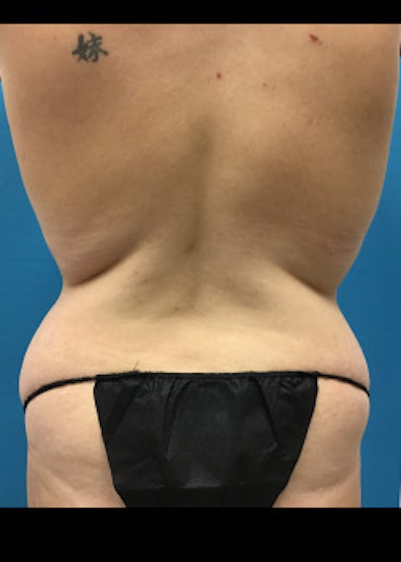 Tummy Tuck Before & After Gallery - Patient 46612080 - Image 7