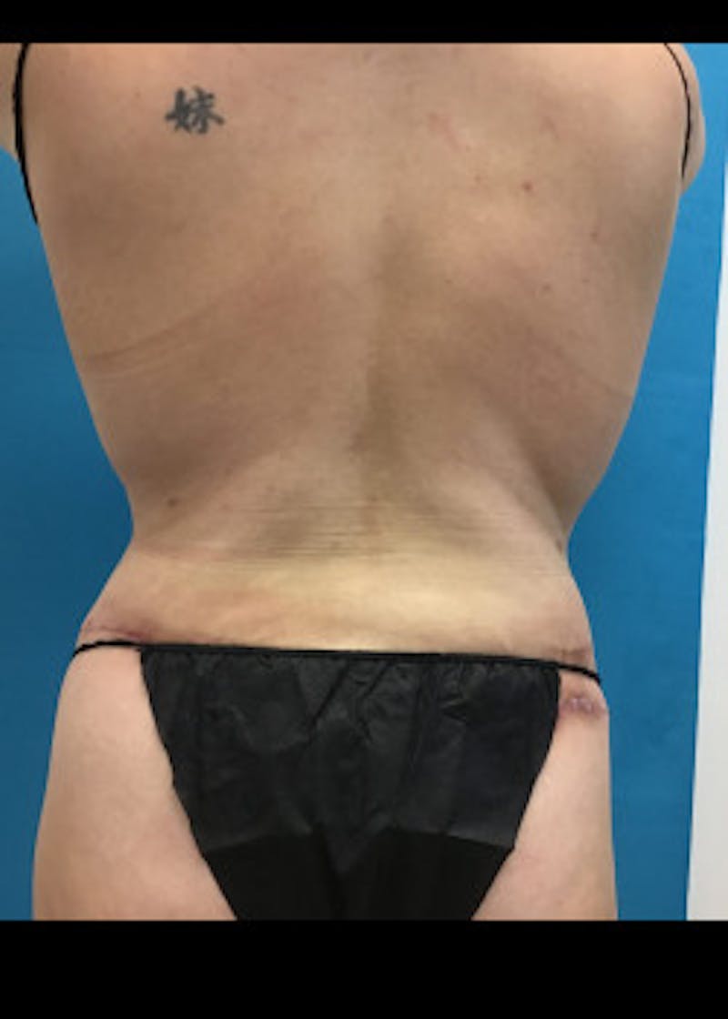 Tummy Tuck Before & After Gallery - Patient 46612080 - Image 8