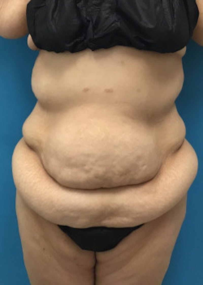 Tummy Tuck Before & After Gallery - Patient 46612081 - Image 1