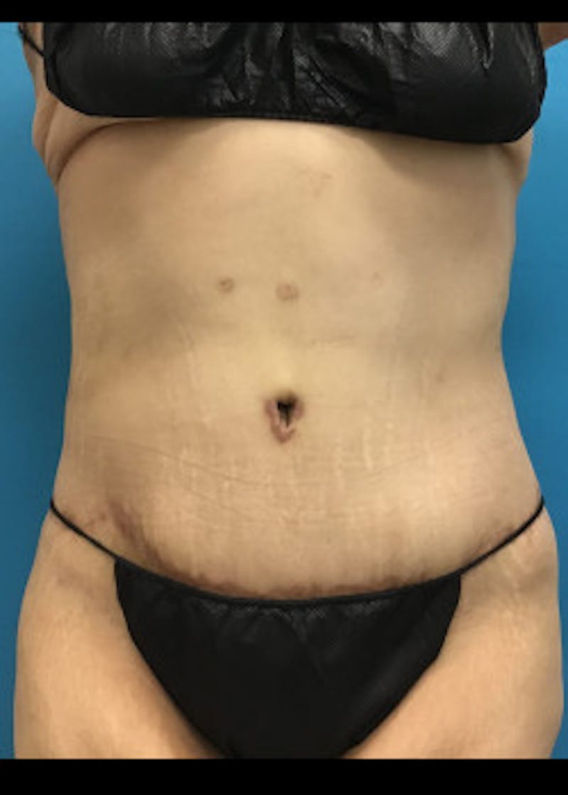 Tummy Tuck Before & After Gallery - Patient 46612081 - Image 2