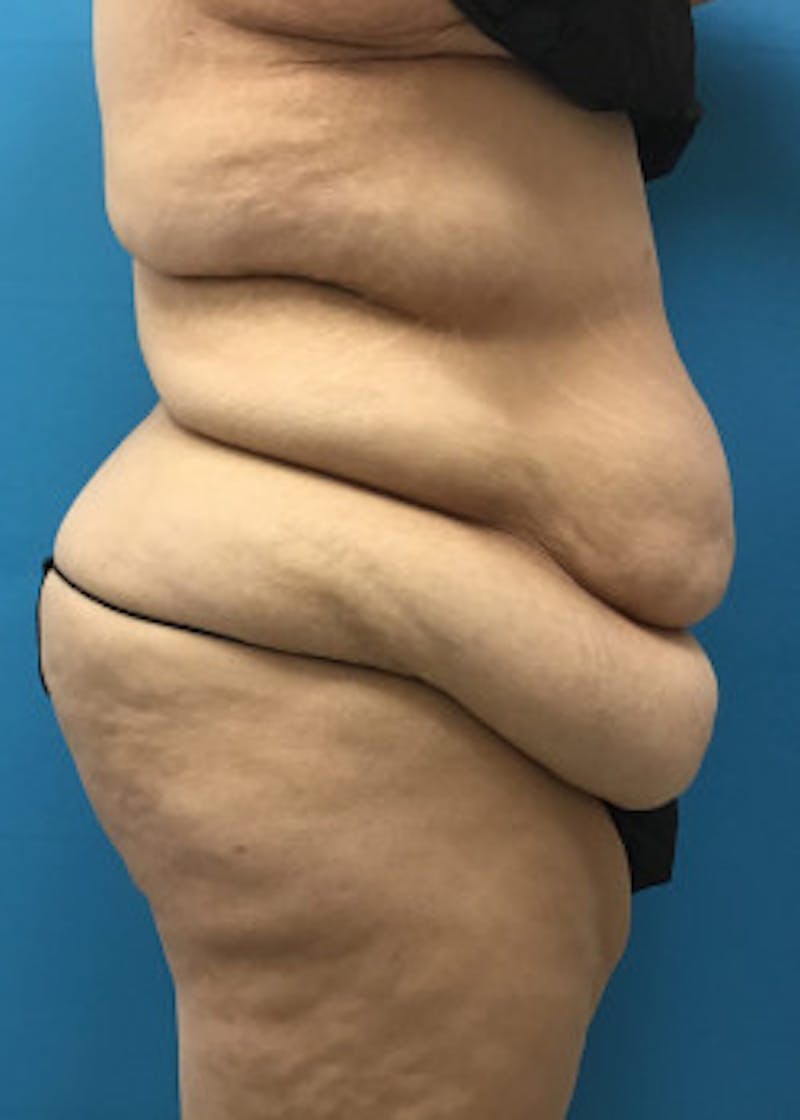 Tummy Tuck Before & After Gallery - Patient 46612081 - Image 3