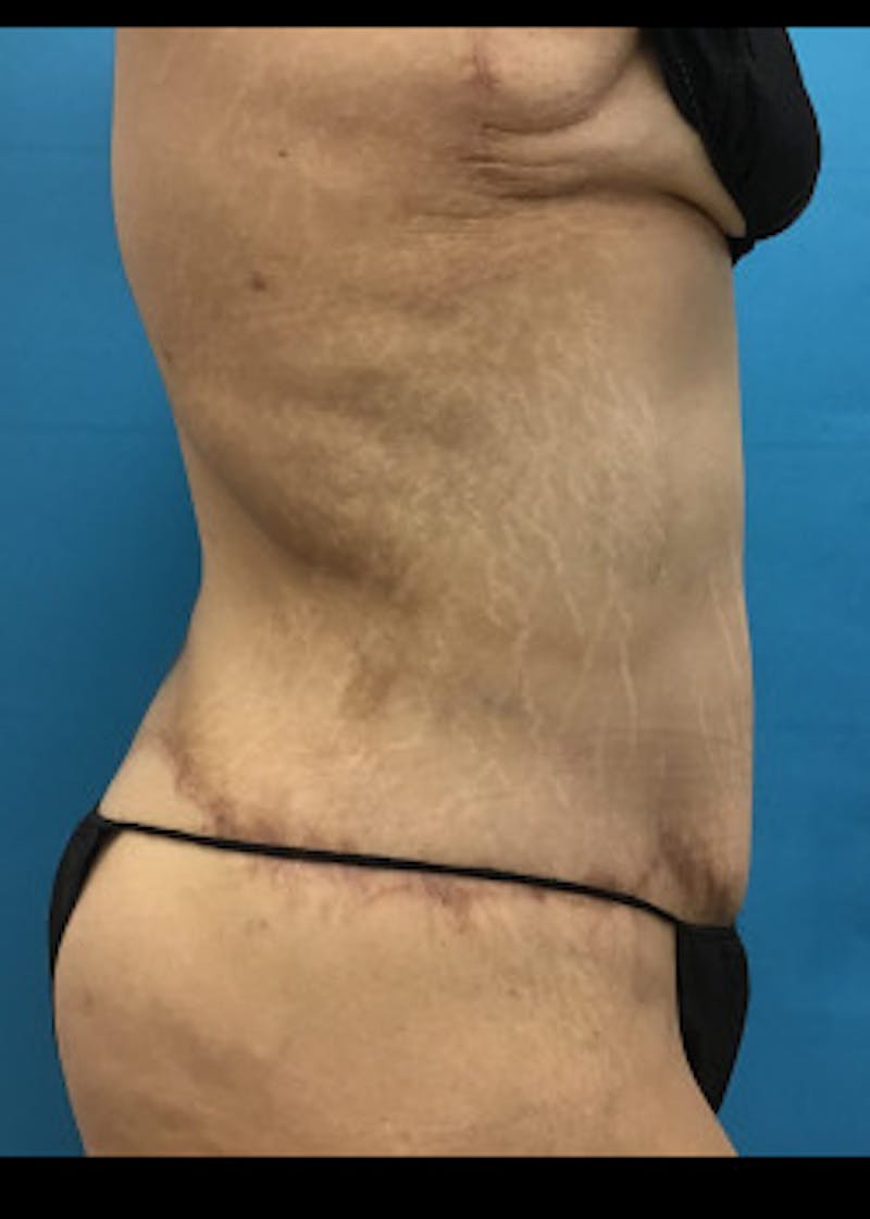 Tummy Tuck Before & After Gallery - Patient 46612081 - Image 4