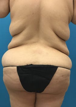Tummy Tuck Gallery - Patient 46612081 - Image 5