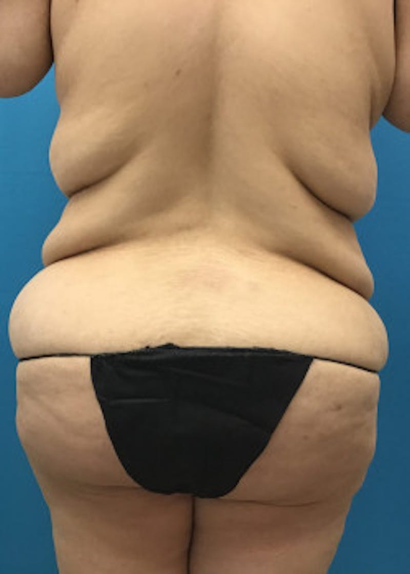 Tummy Tuck Before & After Gallery - Patient 46612081 - Image 5