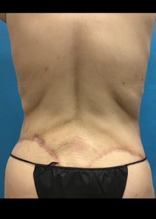 Tummy Tuck Before & After Gallery - Patient 46612081 - Image 6