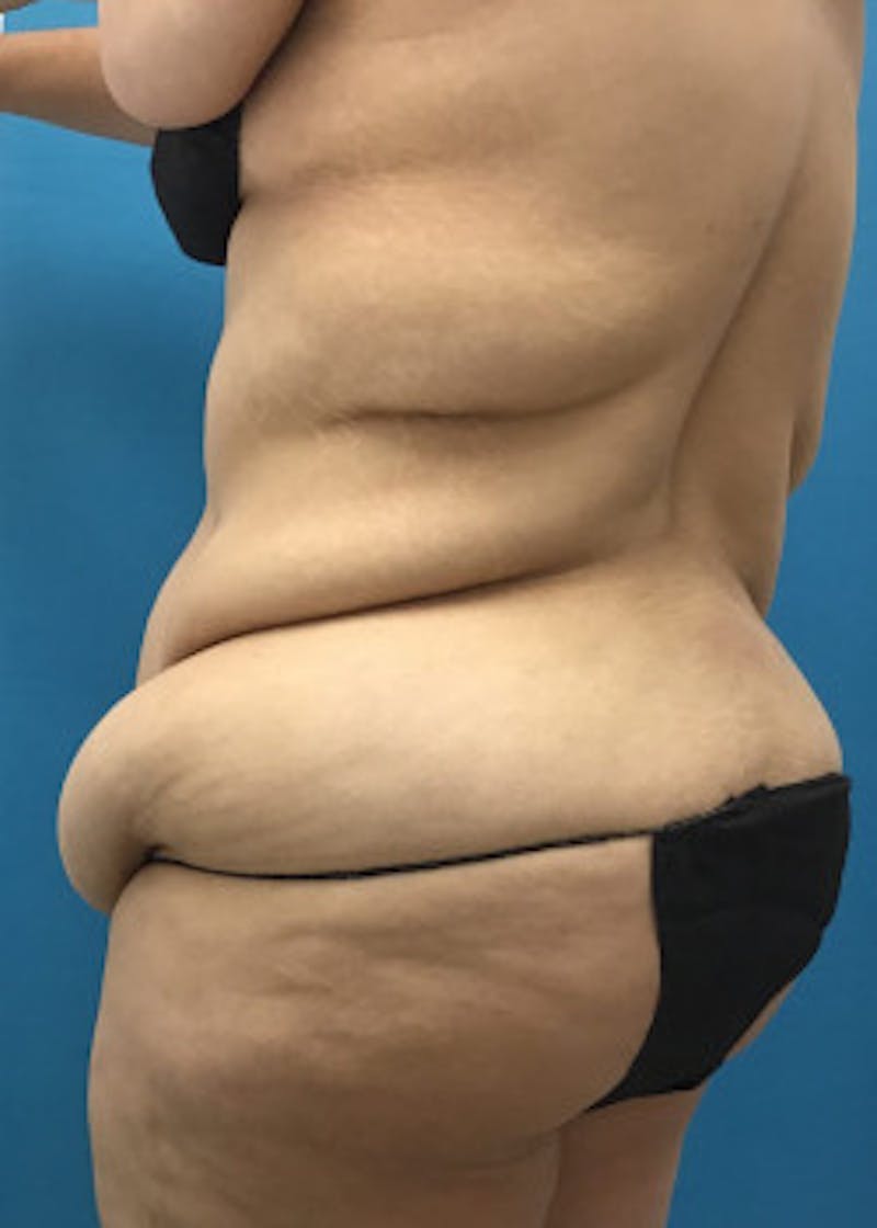 Tummy Tuck Before & After Gallery - Patient 46612081 - Image 7