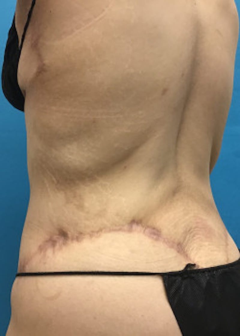 Tummy Tuck Before & After Gallery - Patient 46612081 - Image 8