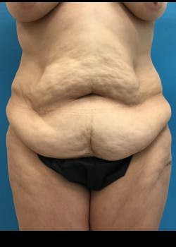 Tummy Tuck Gallery - Patient 46612083 - Image 1