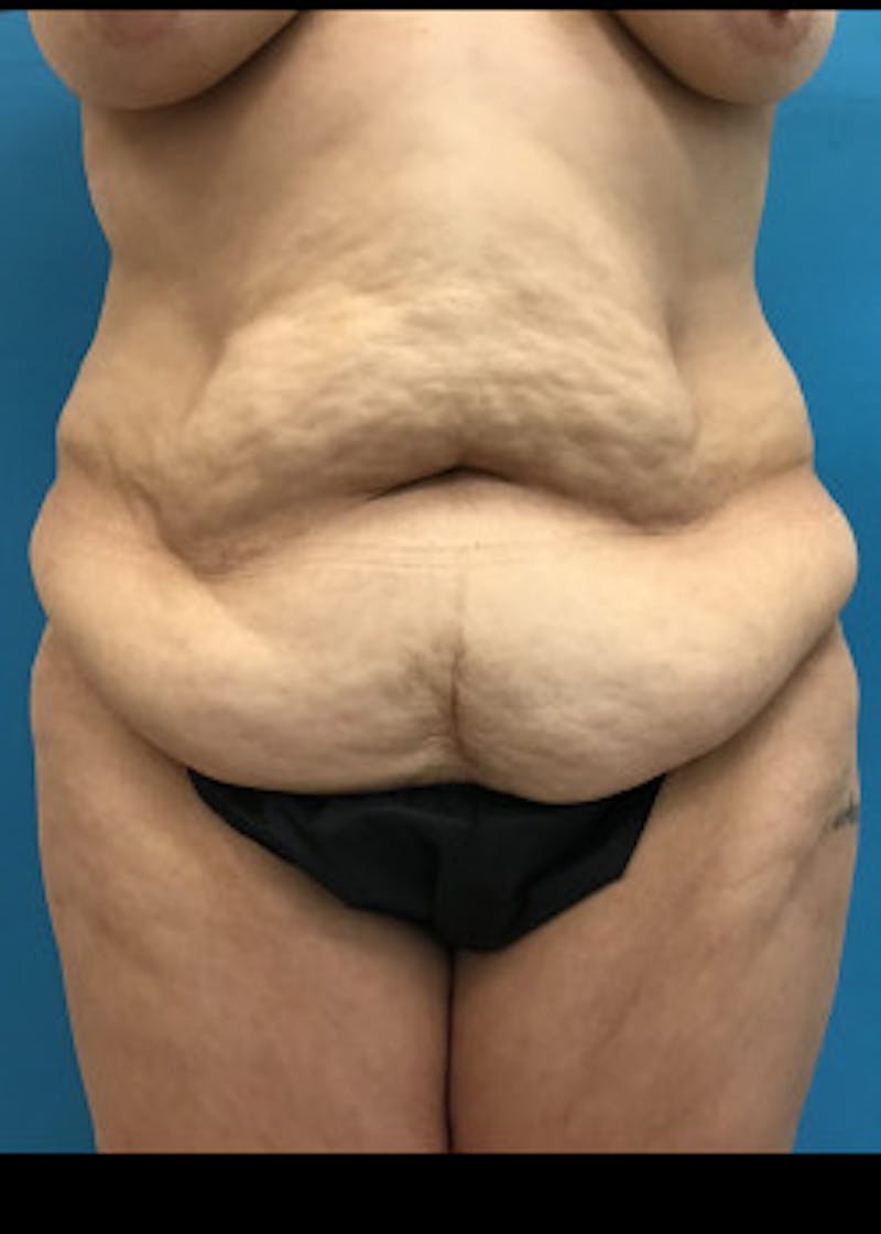 Tummy Tuck Before & After Gallery - Patient 46612083 - Image 1