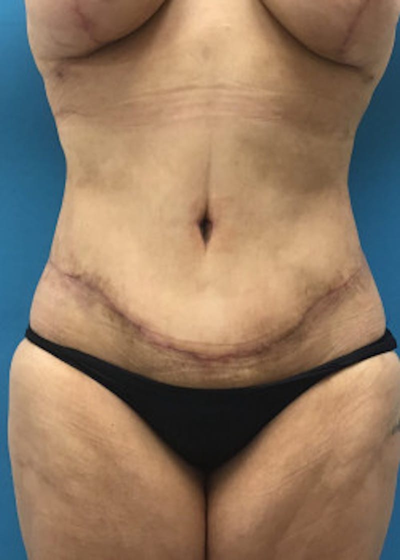 Tummy Tuck Before & After Gallery - Patient 46612083 - Image 2