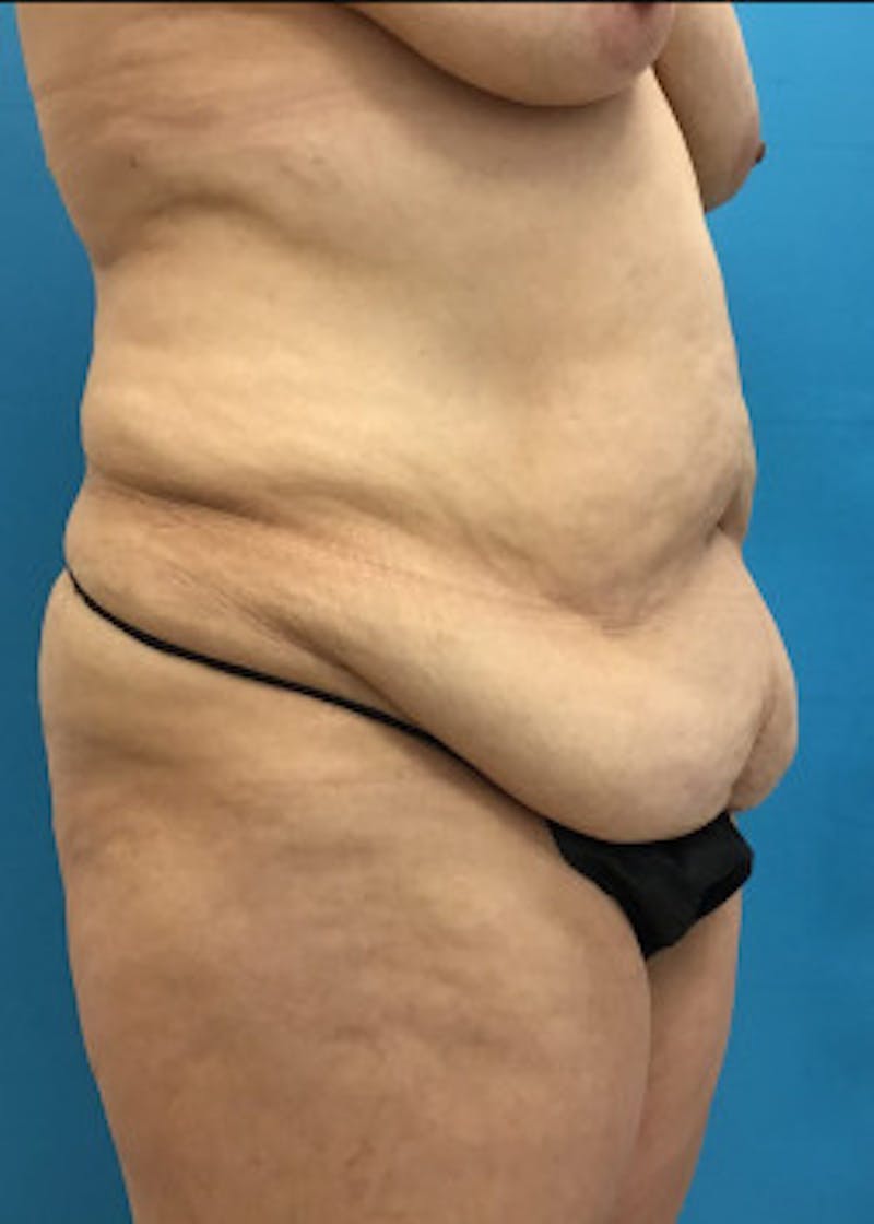 Tummy Tuck Before & After Gallery - Patient 46612083 - Image 3