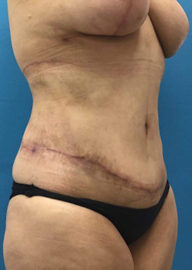 Tummy Tuck Before & After Gallery - Patient 46612083 - Image 4