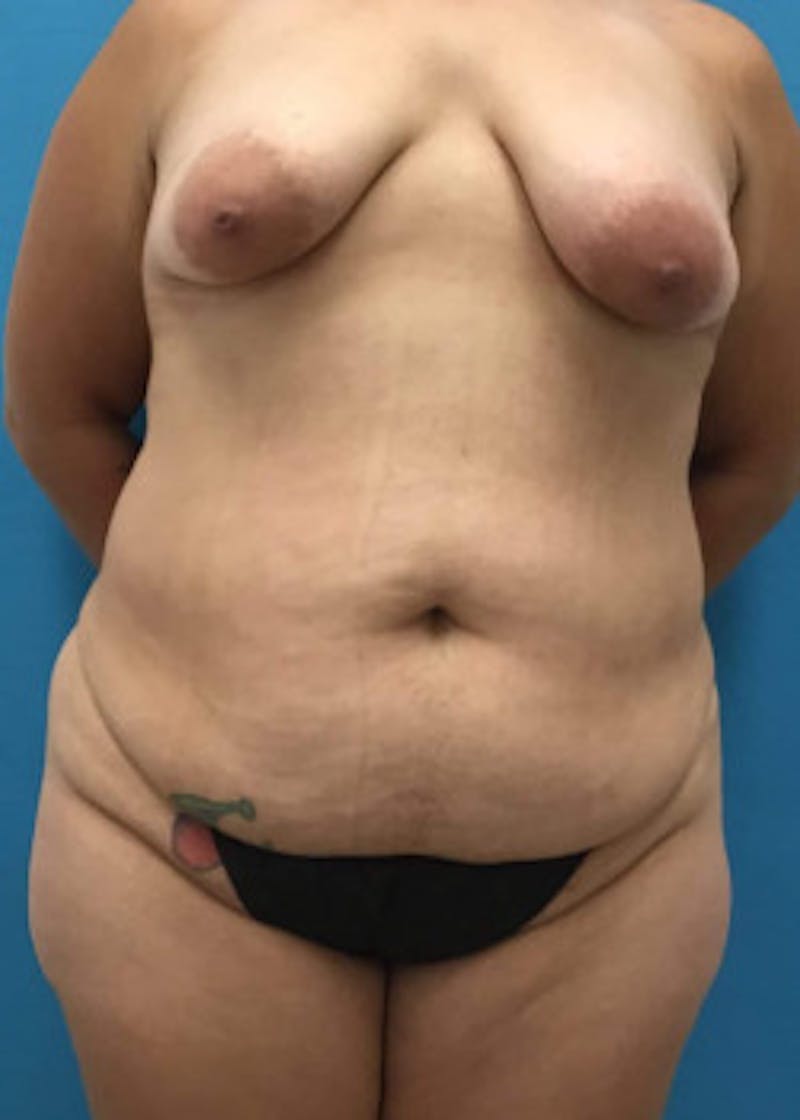 Tummy Tuck Before & After Gallery - Patient 46612086 - Image 1