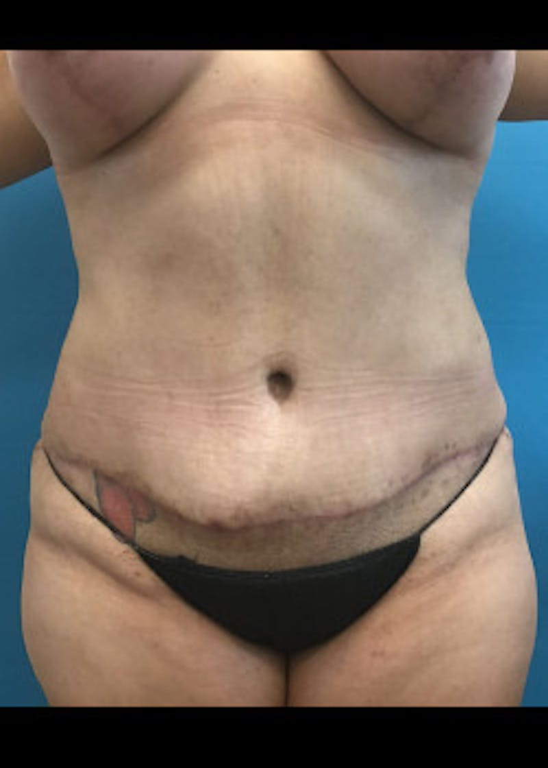 Tummy Tuck Before & After Gallery - Patient 46612086 - Image 2
