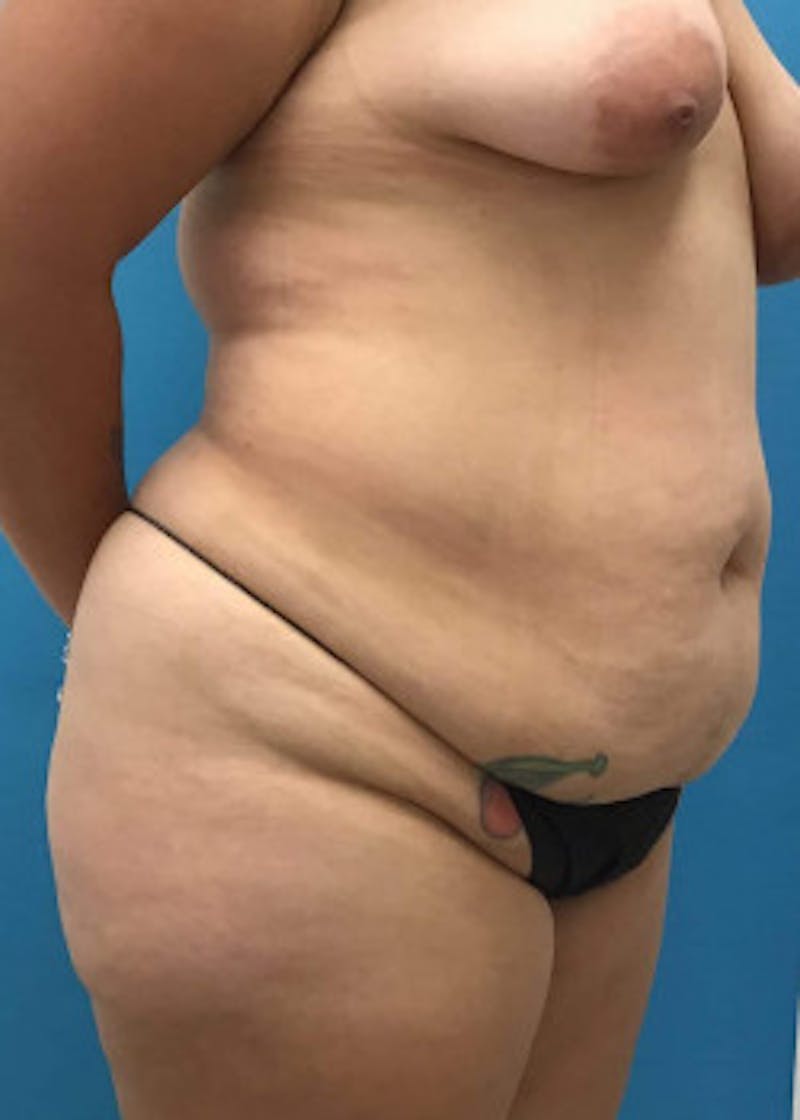 Tummy Tuck Before & After Gallery - Patient 46612086 - Image 3