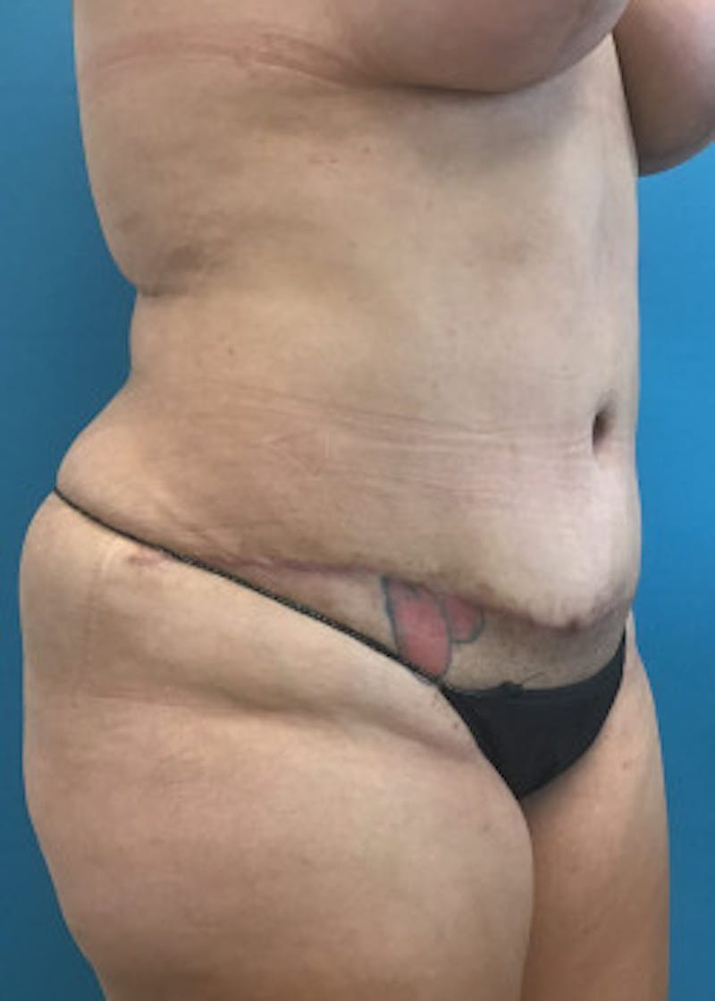 Tummy Tuck Before & After Gallery - Patient 46612086 - Image 4