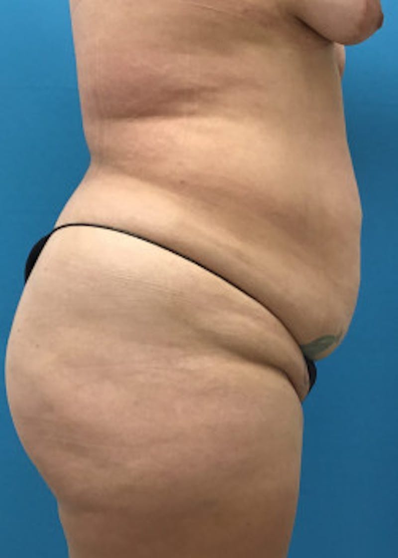 Tummy Tuck Before & After Gallery - Patient 46612086 - Image 5