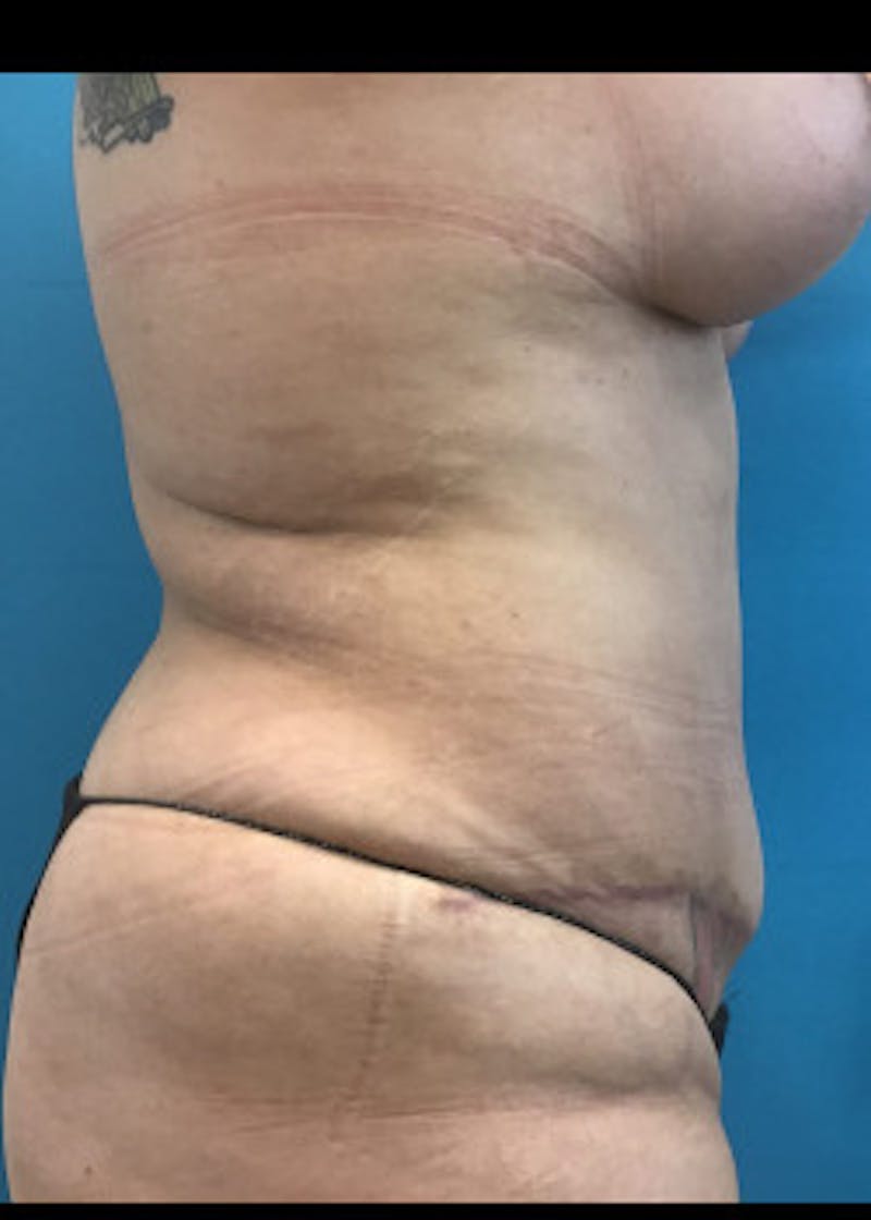 Tummy Tuck Before & After Gallery - Patient 46612086 - Image 6