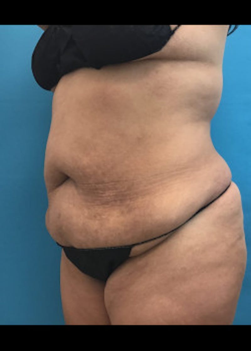 Tummy Tuck Before & After Gallery - Patient 46612119 - Image 1