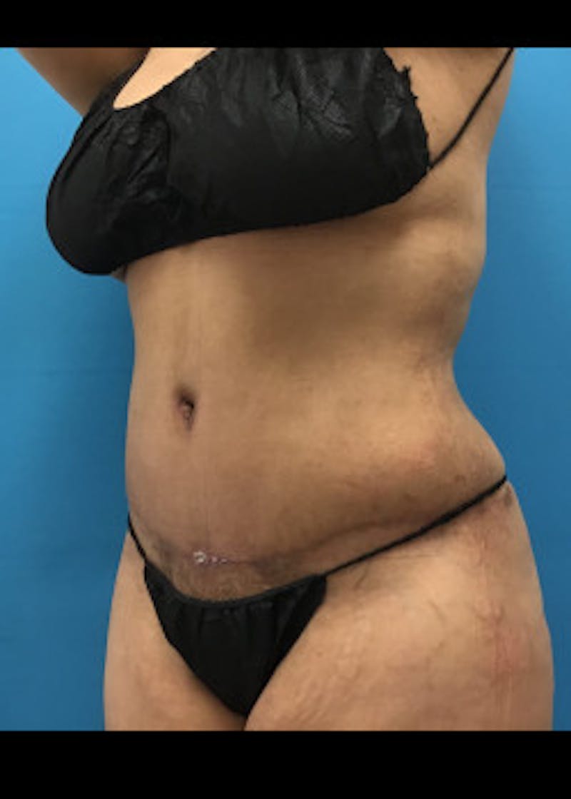 Tummy Tuck Before & After Gallery - Patient 46612119 - Image 2