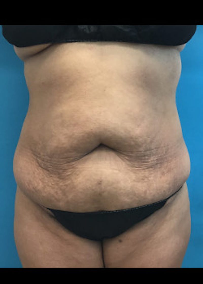 Tummy Tuck Before & After Gallery - Patient 46612119 - Image 3