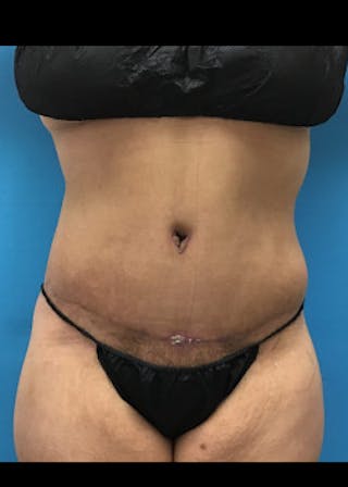 Tummy Tuck Before & After Gallery - Patient 46612119 - Image 2