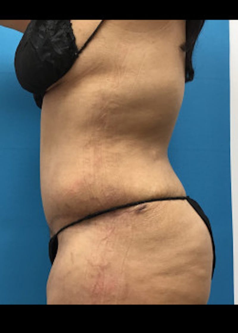 Tummy Tuck Before & After Gallery - Patient 46612119 - Image 6