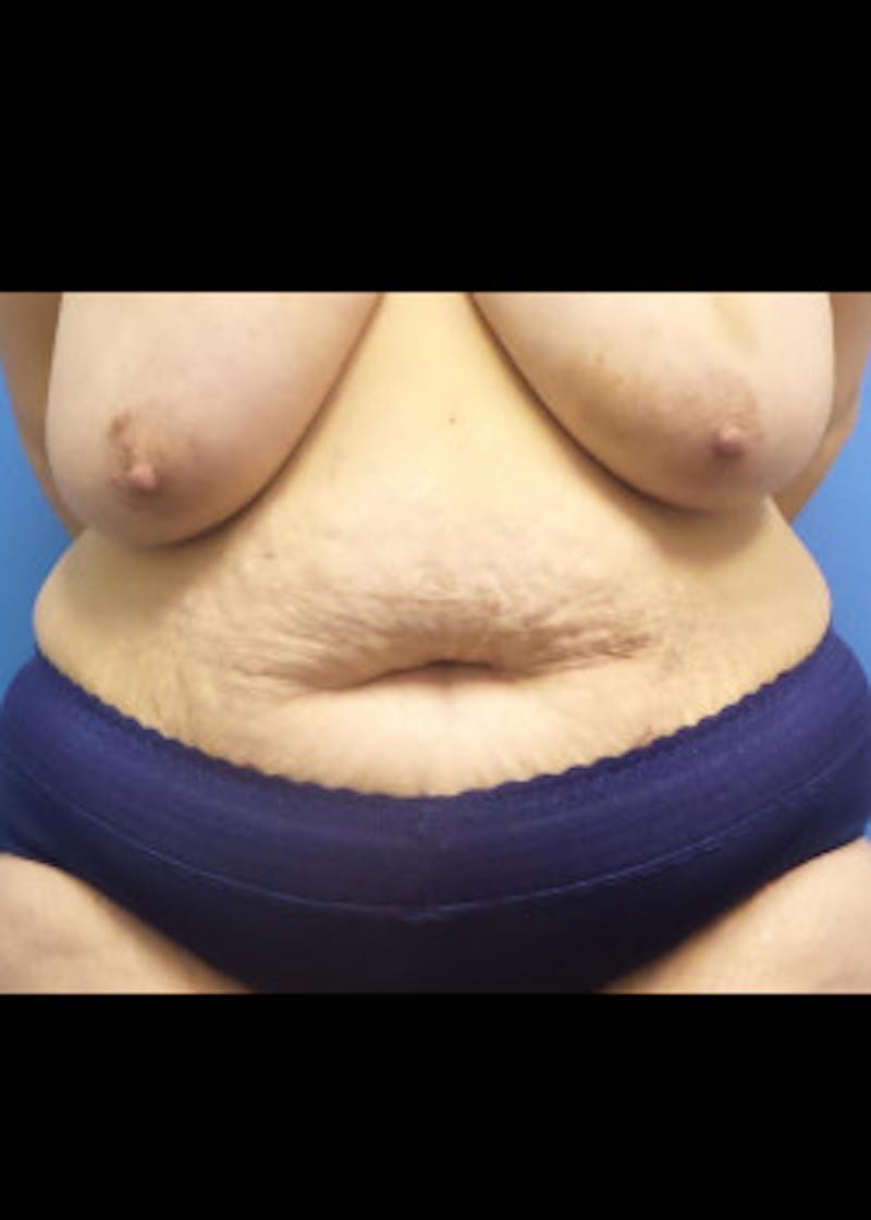 Tummy Tuck Before & After Gallery - Patient 46612166 - Image 3