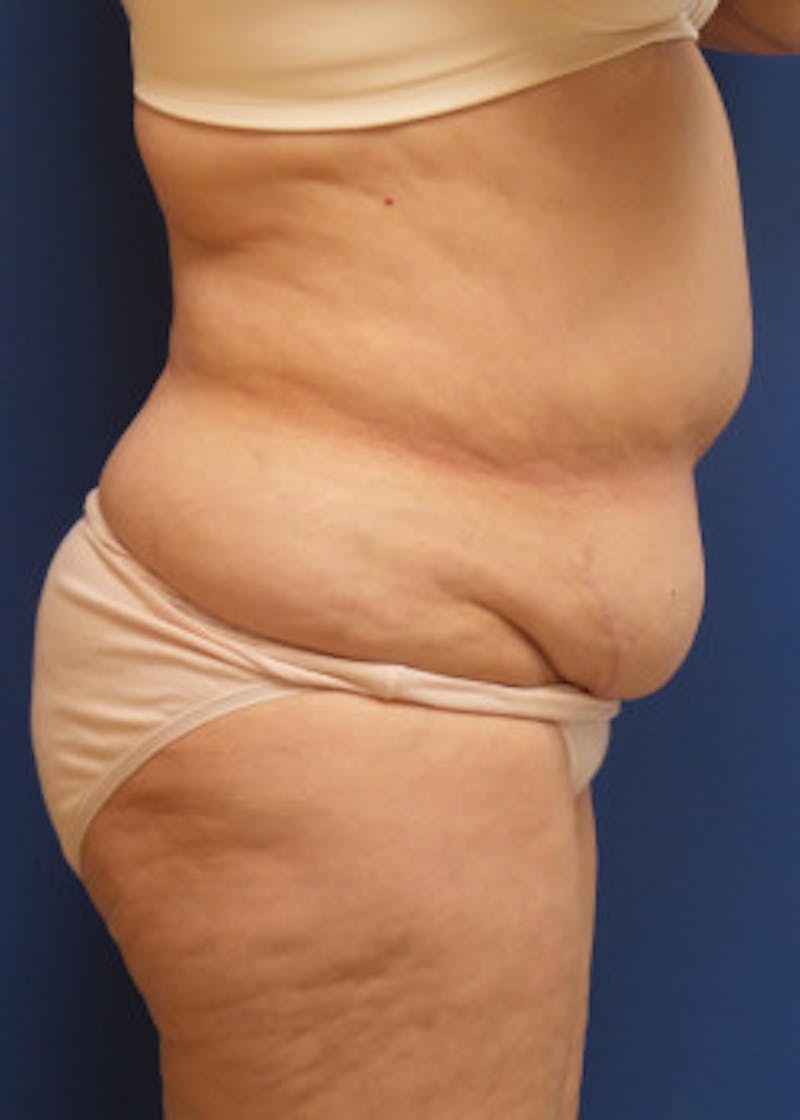 Tummy Tuck Before & After Gallery - Patient 46612181 - Image 1