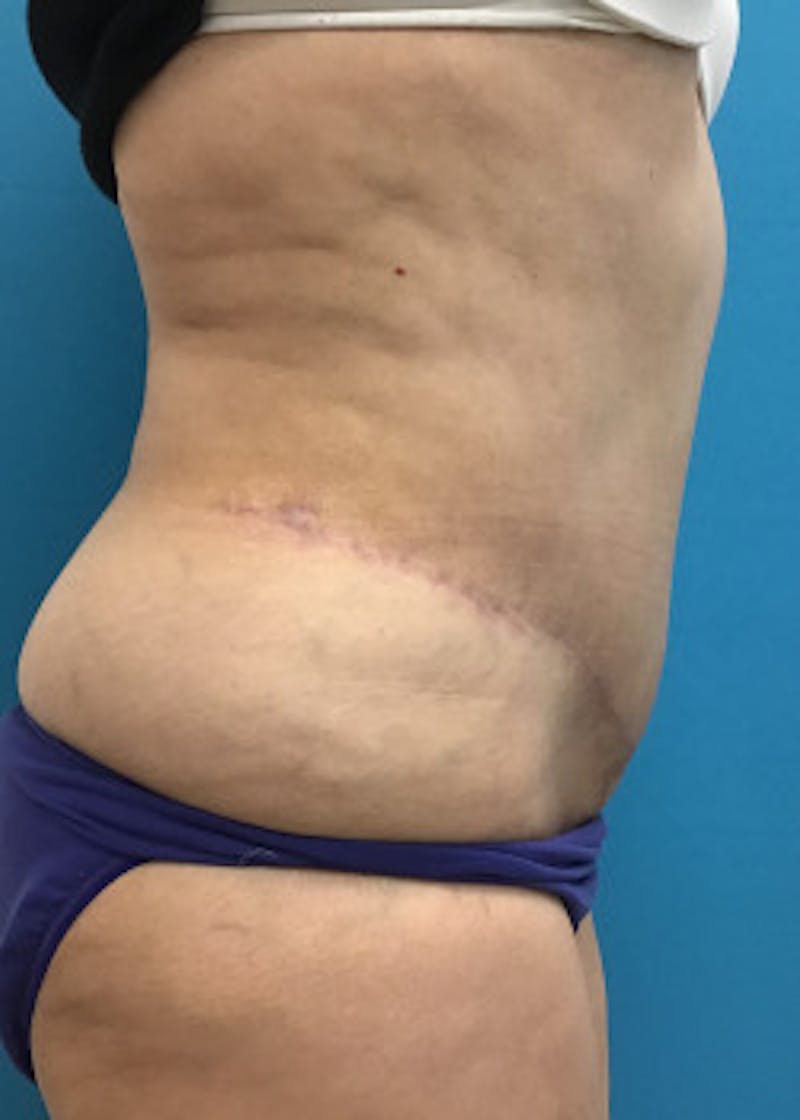 Tummy Tuck Before & After Gallery - Patient 46612181 - Image 2