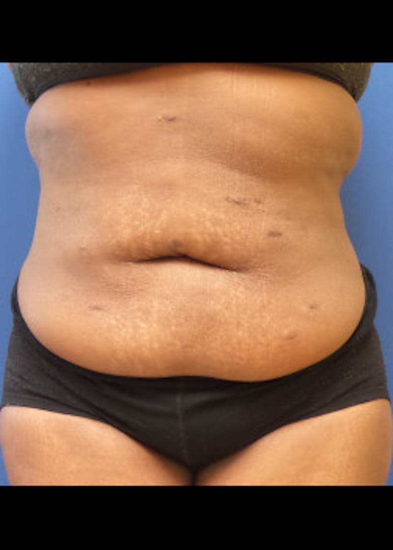 Tummy Tuck Before & After Gallery - Patient 46612182 - Image 1