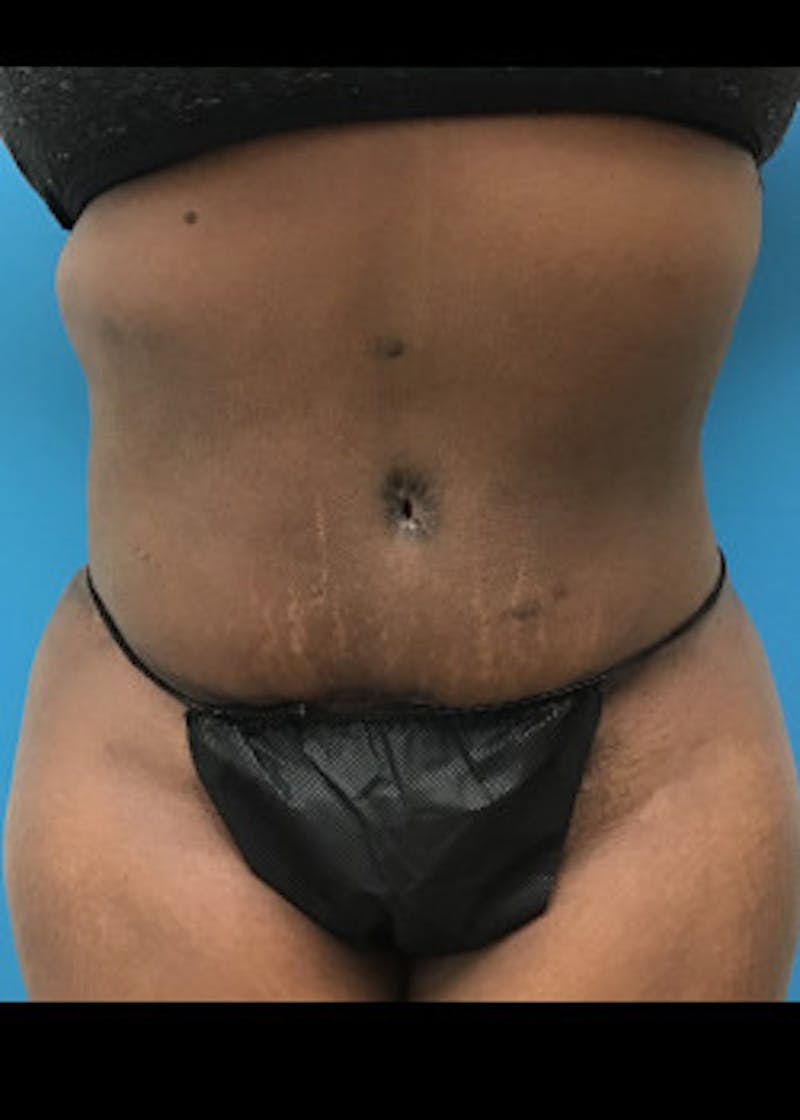 Tummy Tuck Before & After Gallery - Patient 46612182 - Image 2