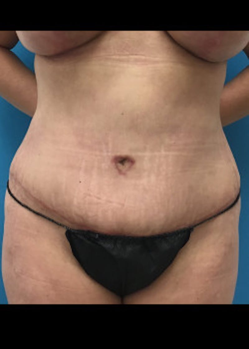 Tummy Tuck Before & After Gallery - Patient 46612189 - Image 2