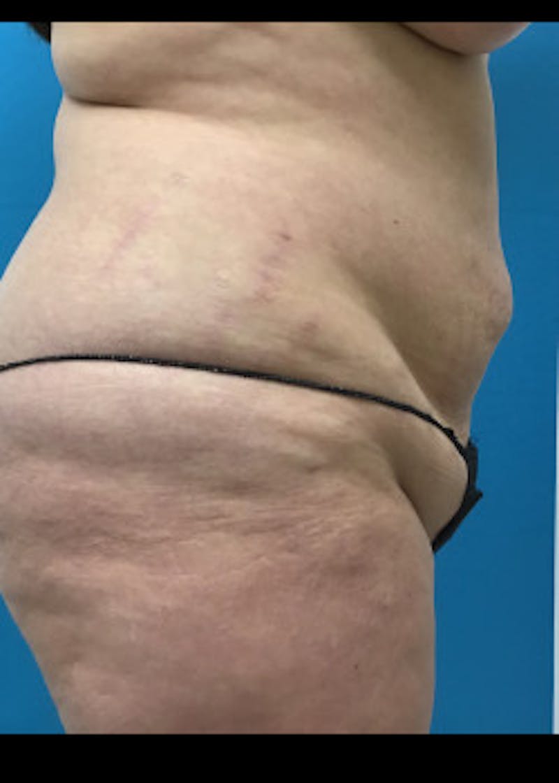 Tummy Tuck Before & After Gallery - Patient 46612189 - Image 3
