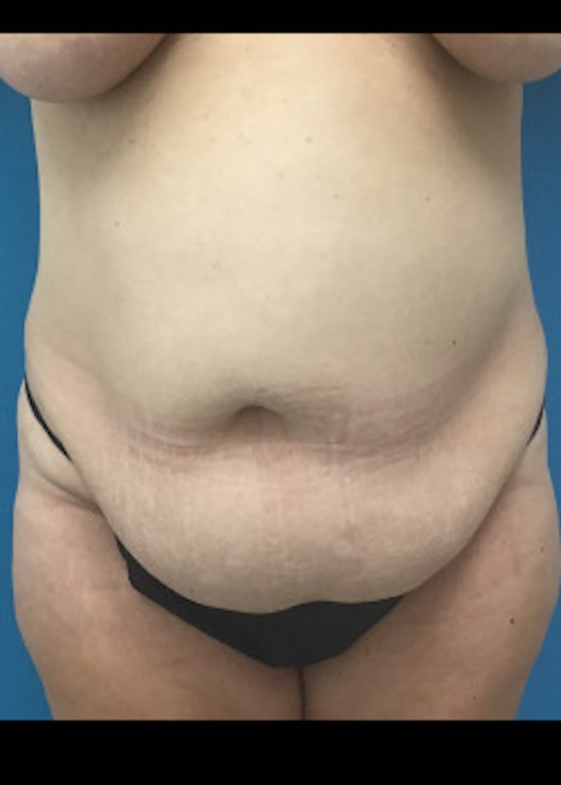 Tummy Tuck Before & After Gallery - Patient 46612214 - Image 1