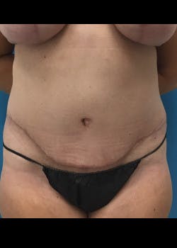 Tummy Tuck Gallery - Patient 46612214 - Image 2