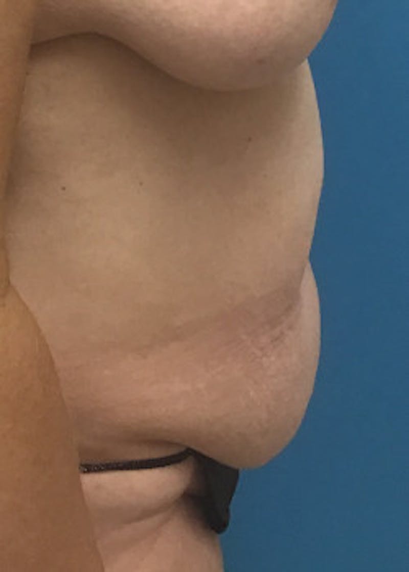 Tummy Tuck Before & After Gallery - Patient 46612214 - Image 3