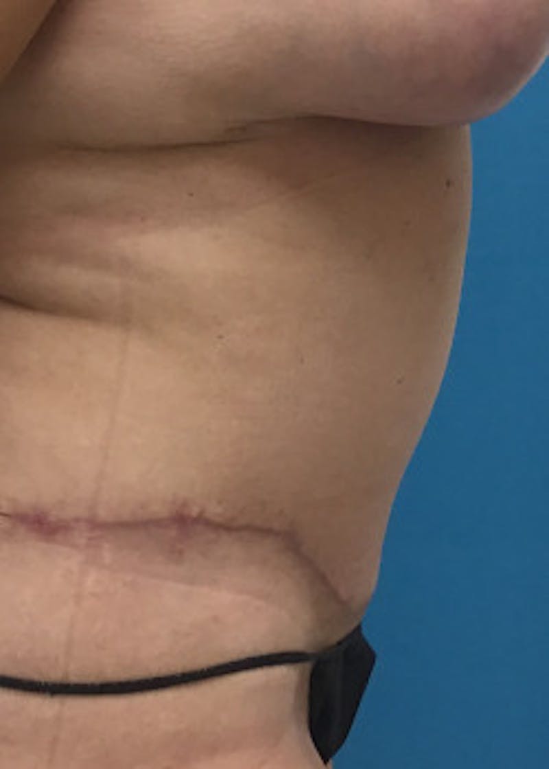 Tummy Tuck Before & After Gallery - Patient 46612214 - Image 4