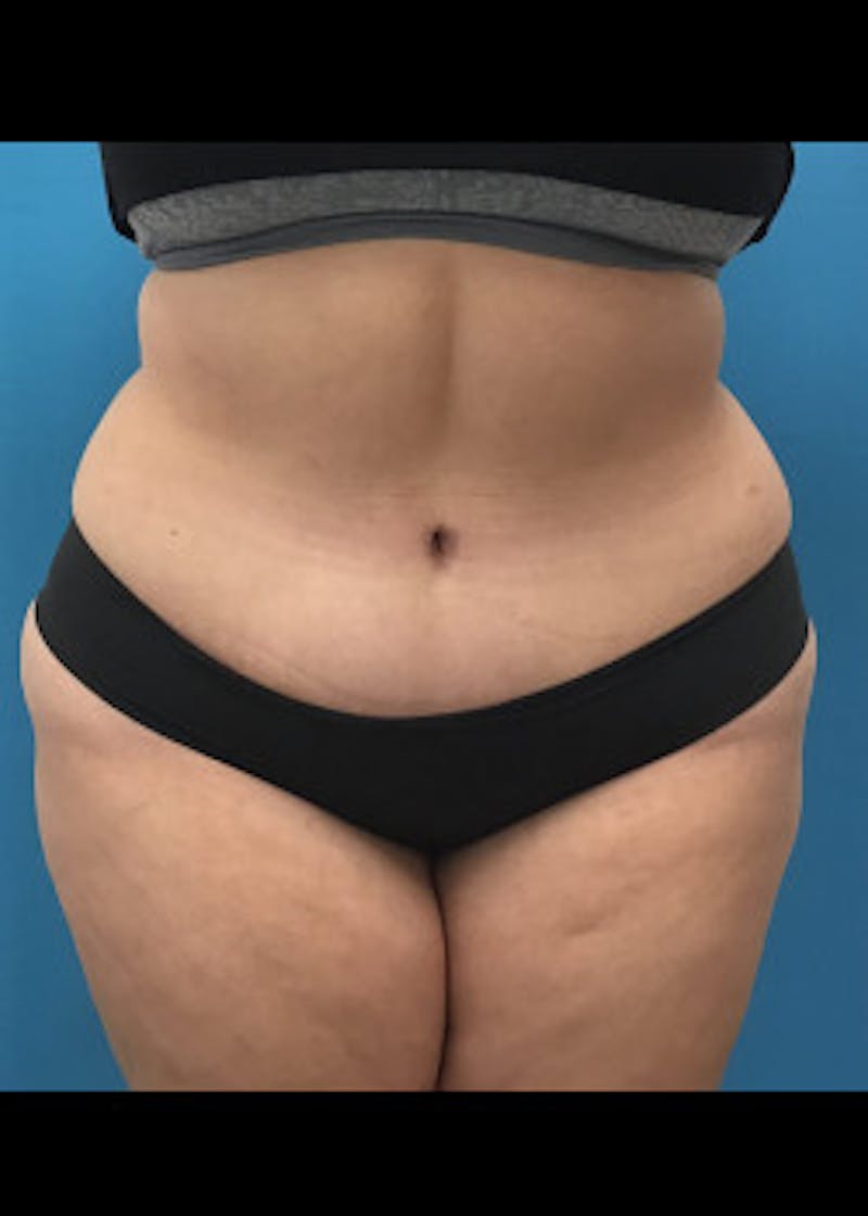 Tummy Tuck Before & After Gallery - Patient 46612265 - Image 2