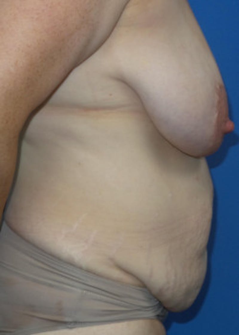 Tummy Tuck Before & After Gallery - Patient 46612280 - Image 3