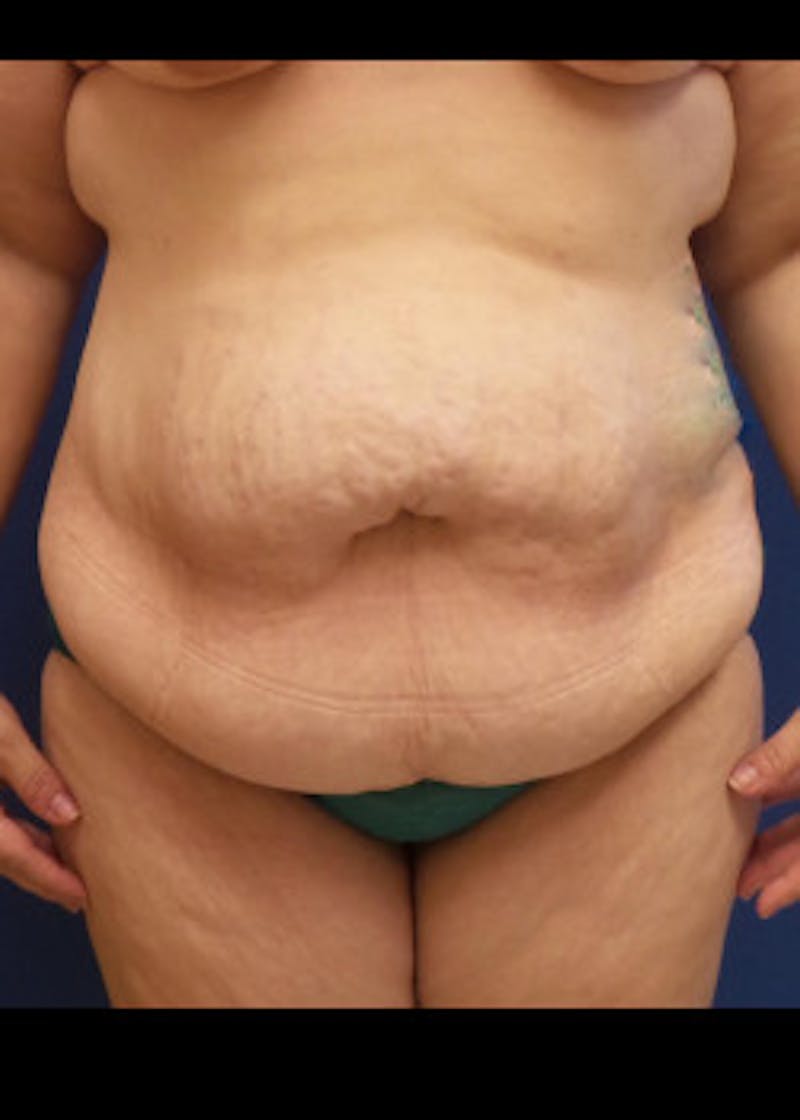 Tummy Tuck Before & After Gallery - Patient 46612299 - Image 1