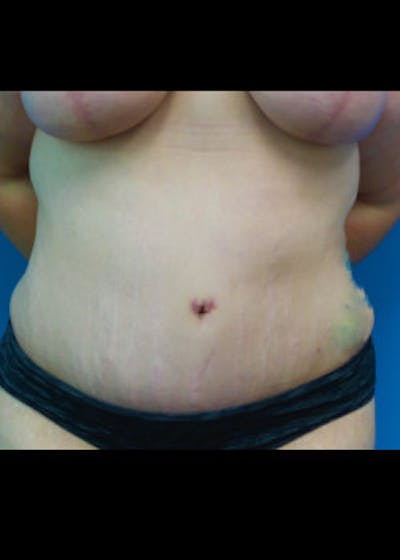 Tummy Tuck Before & After Gallery - Patient 46612299 - Image 2