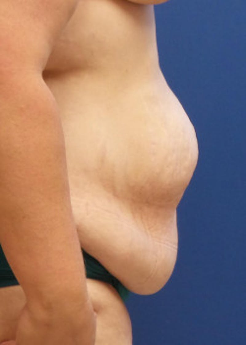 Tummy Tuck Before & After Gallery - Patient 46612299 - Image 3