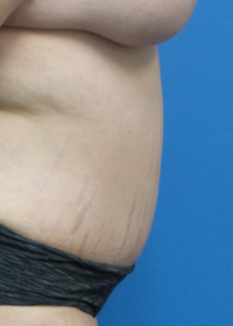 Tummy Tuck Before & After Gallery - Patient 46612299 - Image 4