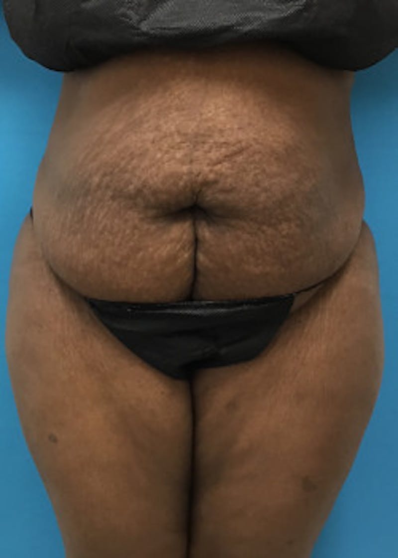 Tummy Tuck Before & After Gallery - Patient 46612356 - Image 1