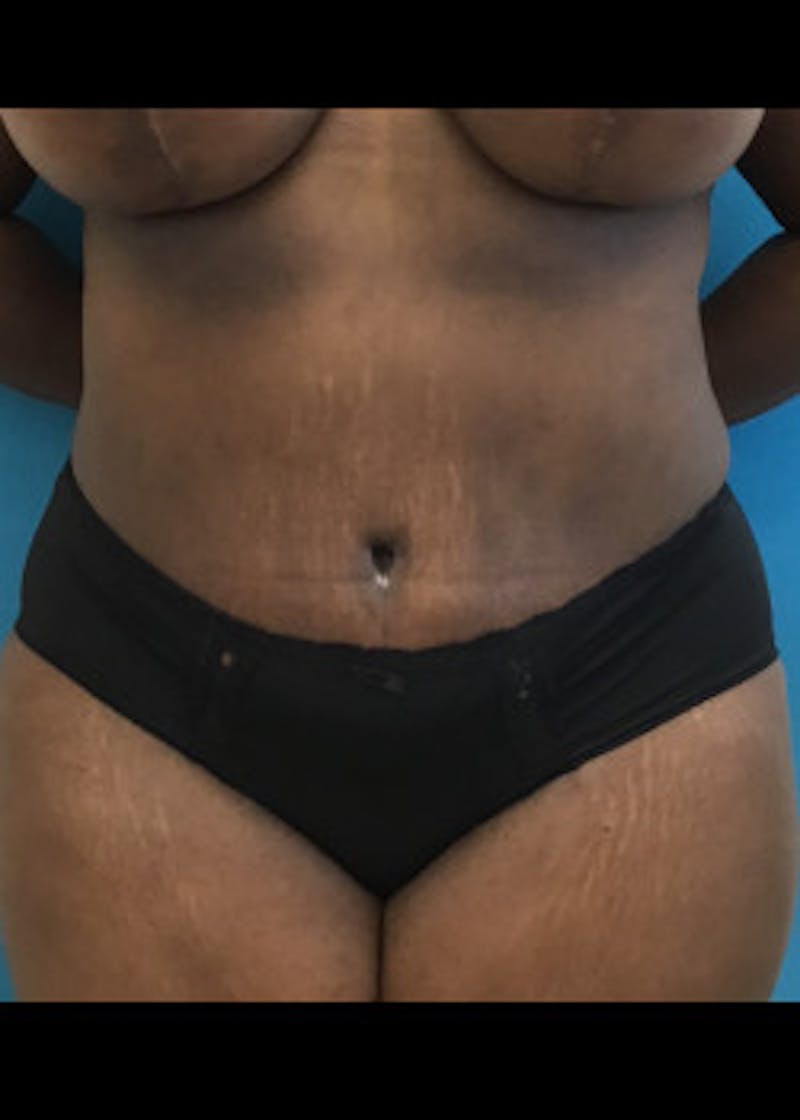 Tummy Tuck Before & After Gallery - Patient 46612356 - Image 2