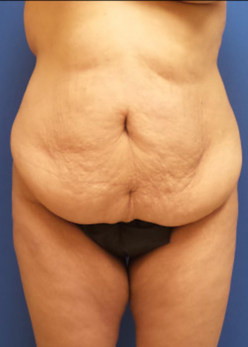 Tummy Tuck Before & After Gallery - Patient 46612396 - Image 1