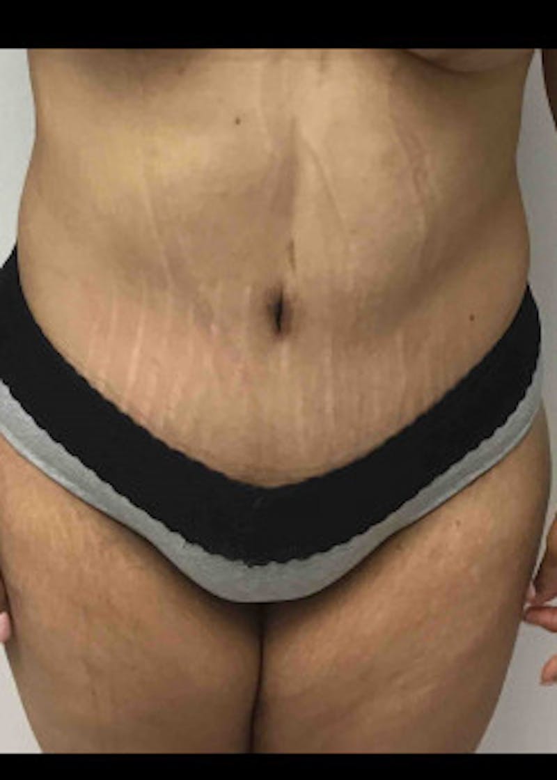 Tummy Tuck Before & After Gallery - Patient 46612396 - Image 2